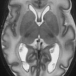 infant brain cervello neonato