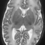 infant brain cervello neonato